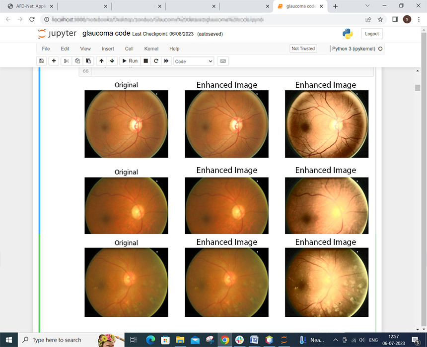 Glaucoma Classification Project